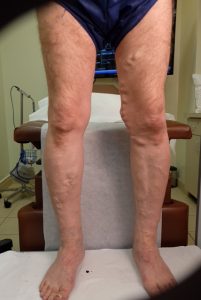 front of legs before varicose vein treatment