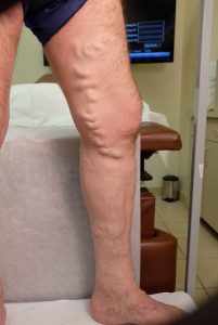 right side leg before Conservative Treatment Chicago