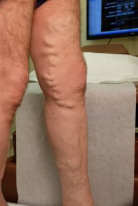 side close up leg before endovenous laser therapy