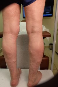 back of legs before vein treatment