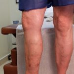 side view leg before varicose vein treatment