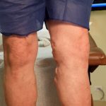 front view of leg before varicose vein treatment