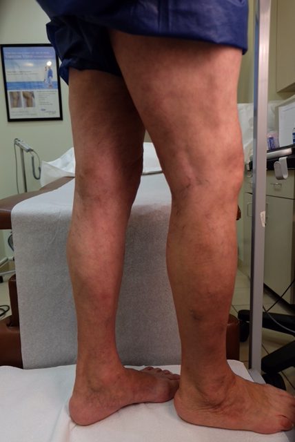 Varicose Veins Treatment Before And After Results Chicago Vein Care Center