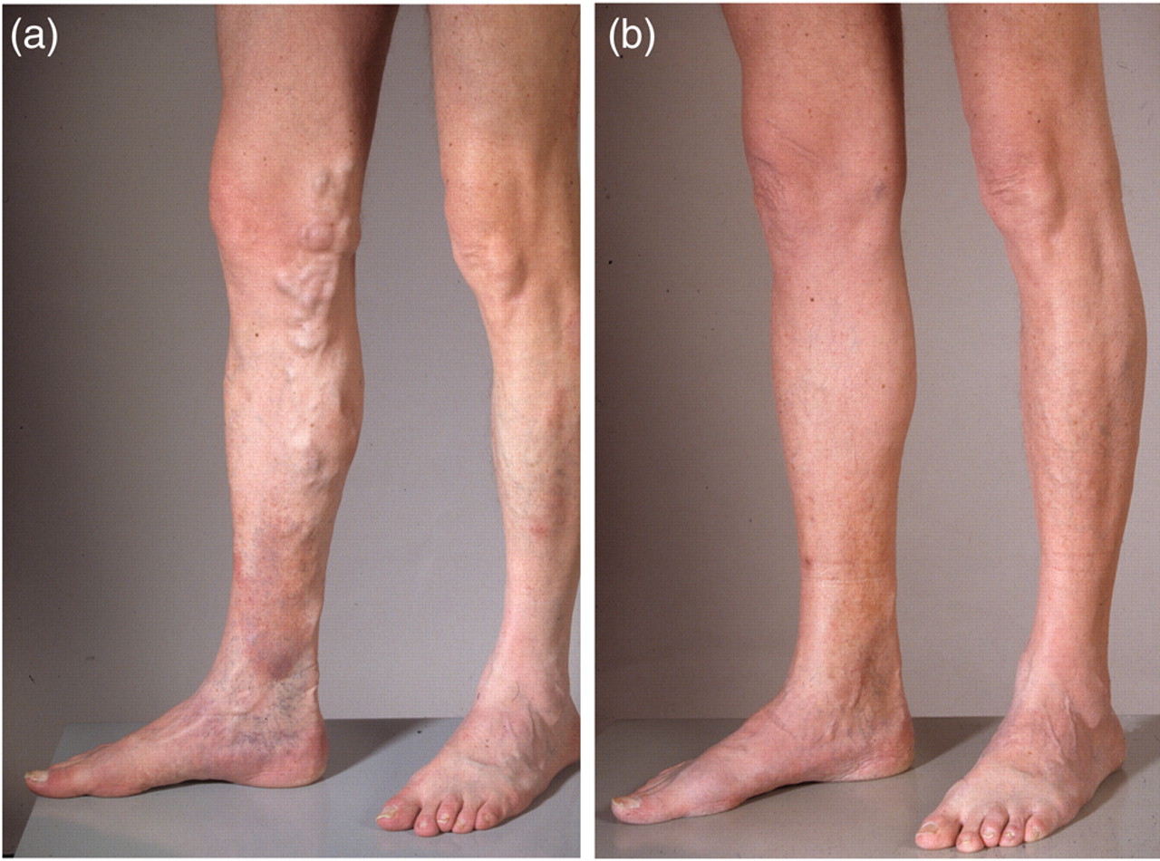 Chicago Vein Care Center Wants You to Know the Unexpected Side Effects of Varicose Veins