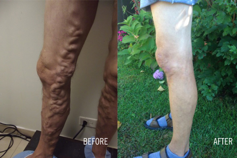Vein Care In Chicago: What Is The Best Way To Treat Varicose Veins?
