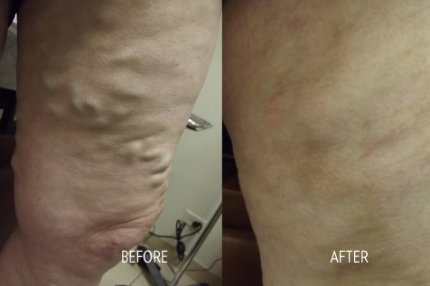 Chicago Vein Care Center Reveals How Chicago Vein Treatment Can Eliminate Varicose Veins For Good