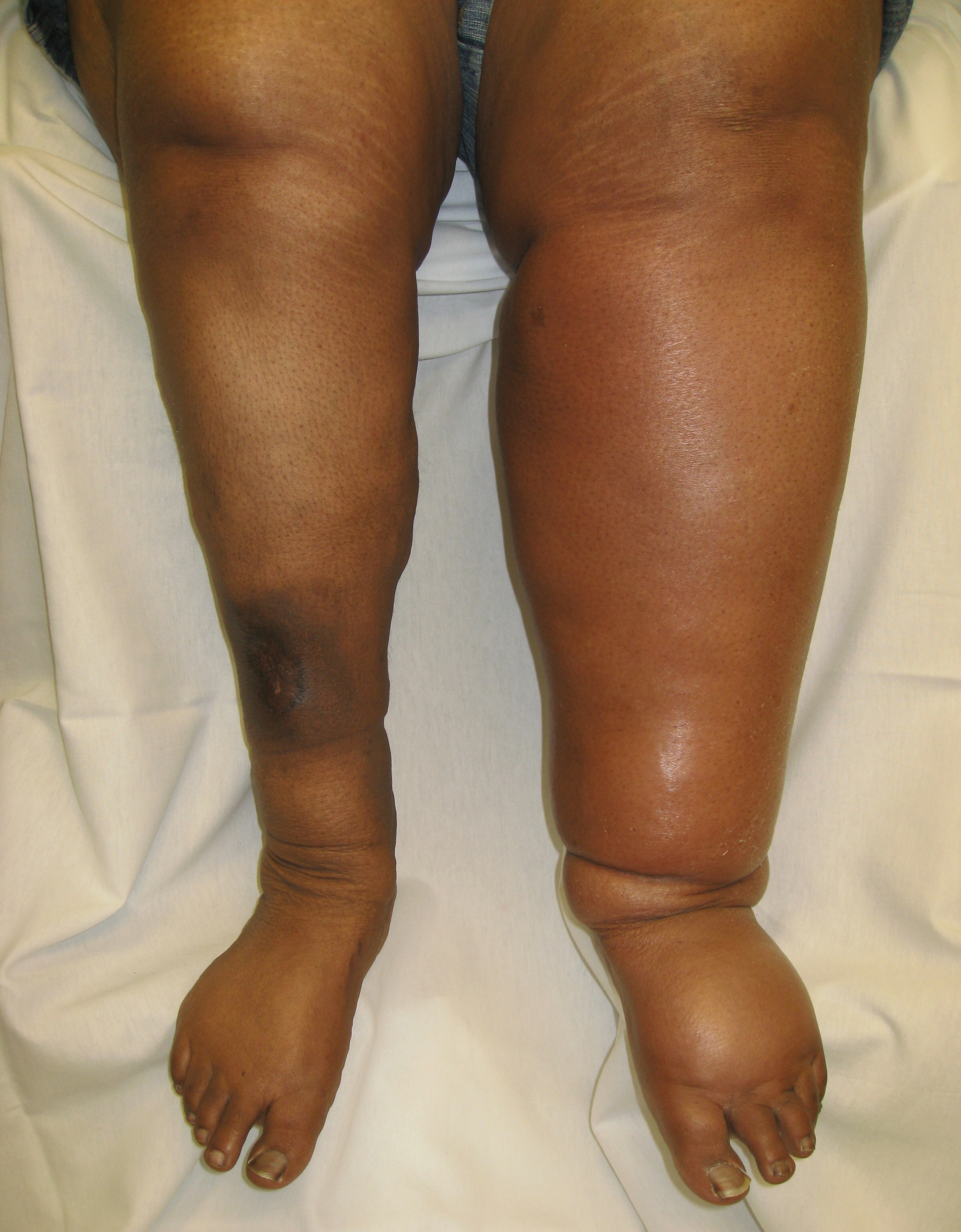 How to Treat Swollen Legs & Ankles Before Turning to Vein Laser Surgery