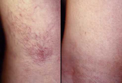 mh_rm_photo_of_before_and_after_sclerotherapy_for_spider_veins.j