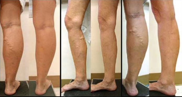 How To Eliminate Varicose Veins In Chicago Residents For Good