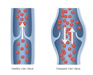 diseasedvein_combined_large