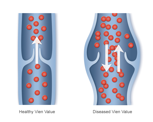 Chicago Vein Care Center On Benefits of Vein Disease Treatment in Chicago