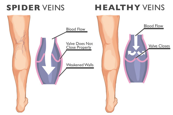 Why Vein Disease Will Send You Running for Help – Straight to Chicago Vein Care Center