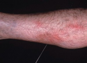 Chicago Vascular Doctor: New Article on Thrombophlebitis