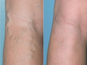 At-home Varicose Vein Treatment in Chicago