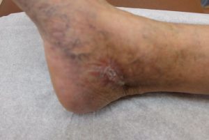 Varicose Vein Treatment in Chicago: Leg Discoloration
